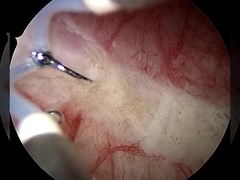 gyn probe for uterine adhesion