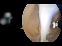arthroscope surgery by rf plasma
