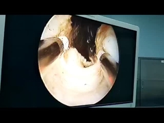 urology bph resection