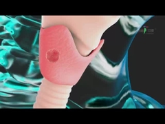 Thyroid tumor ablation