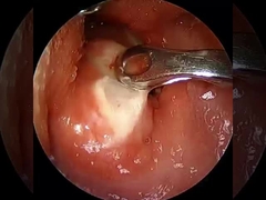 ENT RF Plasma Surgical Machine For Turbinate reduction,andenoidectomy&Tonsil&Throat Surgery