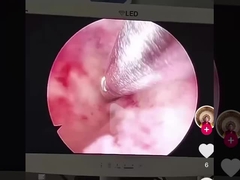 Gynecological Tissue Morcellation Power System