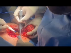 Using Plasma Forcep to do Cutting and Coagulation in Tumor Resection Open Surgery