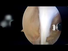 Arthroscope